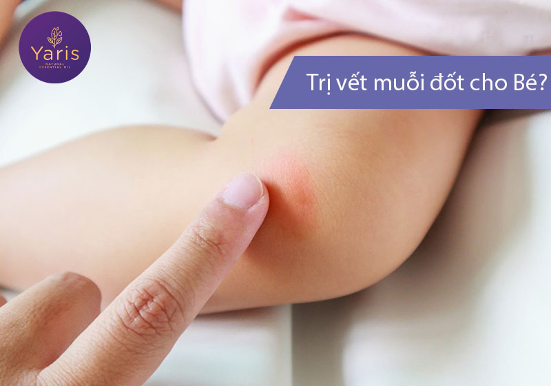 Chỉ Mẹ cách trị vết muỗi đốt cho Bé an toàn